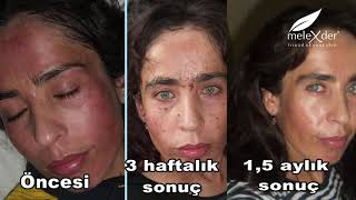 Feraye Hanım'ın değişimi (kişiye ve cilde özel ürünlerin farkı)