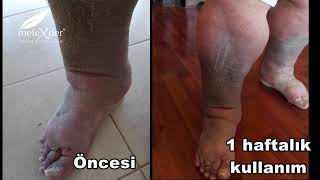 Kişiye Özel Hazırlanan Ürünlerimizle Aldığımız Harika Sonuç (FİL HASTALIĞI)