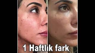 Melexder ile 3 hafta (1. Hafta)